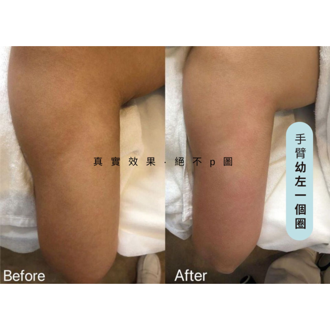 INMODE 爆脂 + 收緊頭 療程(身體/面部)