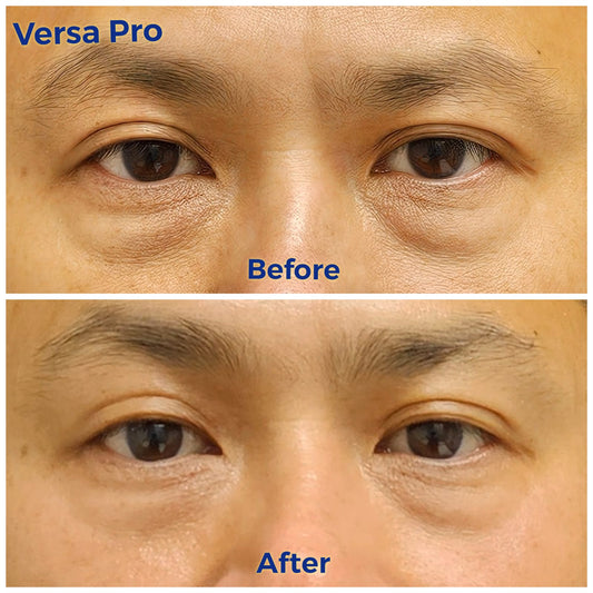 Venus Versa Pro 面部療程