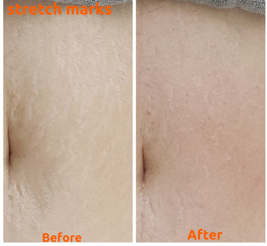 Venus Versa Pro 身體護理療程