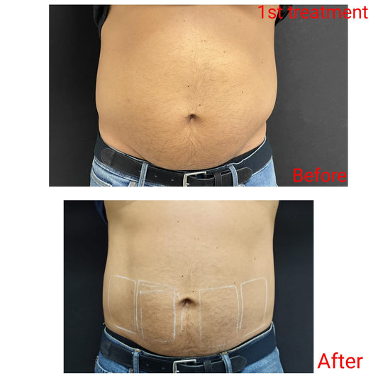 Venus Bliss™ 無創溶脂療程