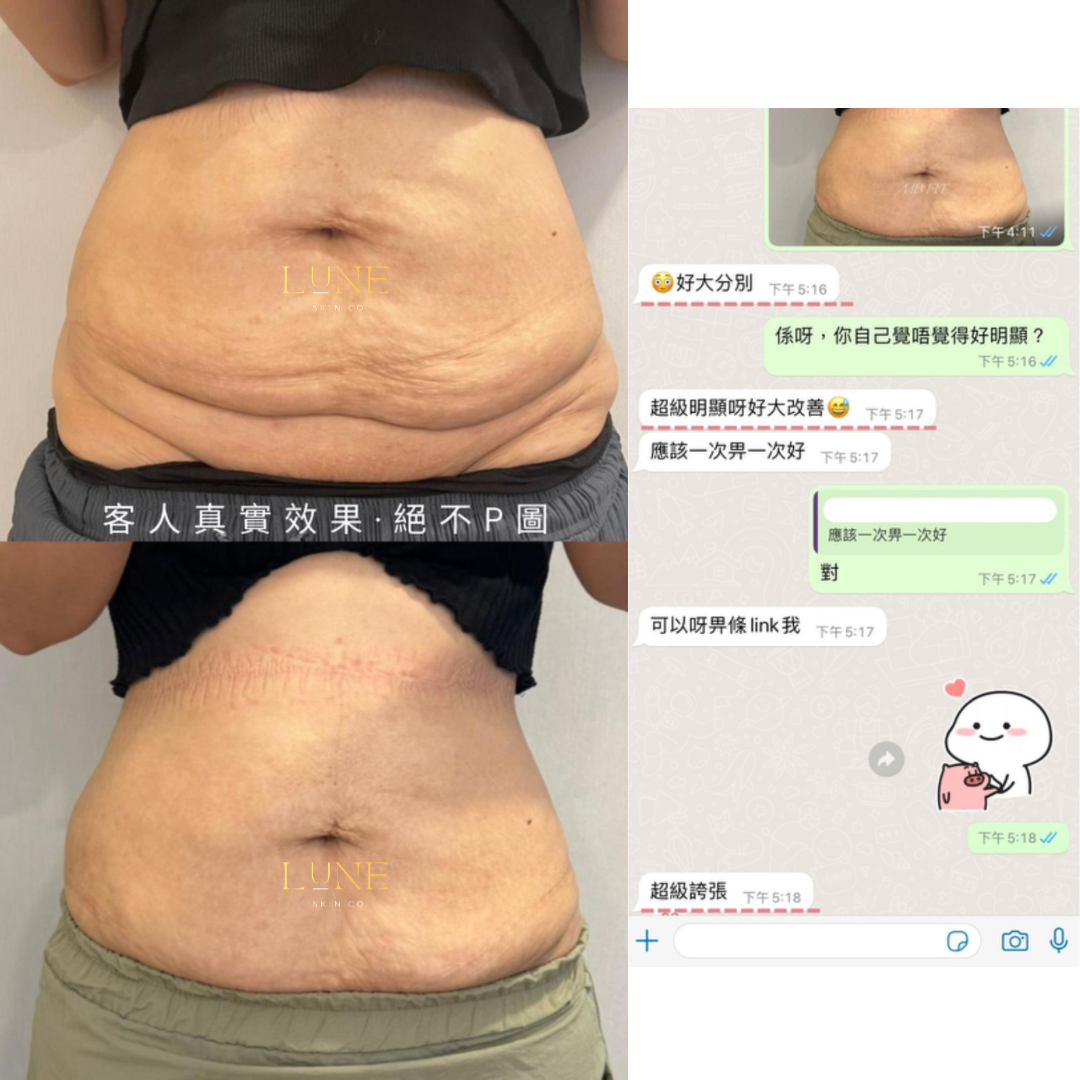 INMODE M8 全方位緊膚塑形療程（身體／面部／頸部）