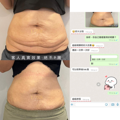INMODE M8 全方位緊膚塑形療程（身體／面部／頸部）