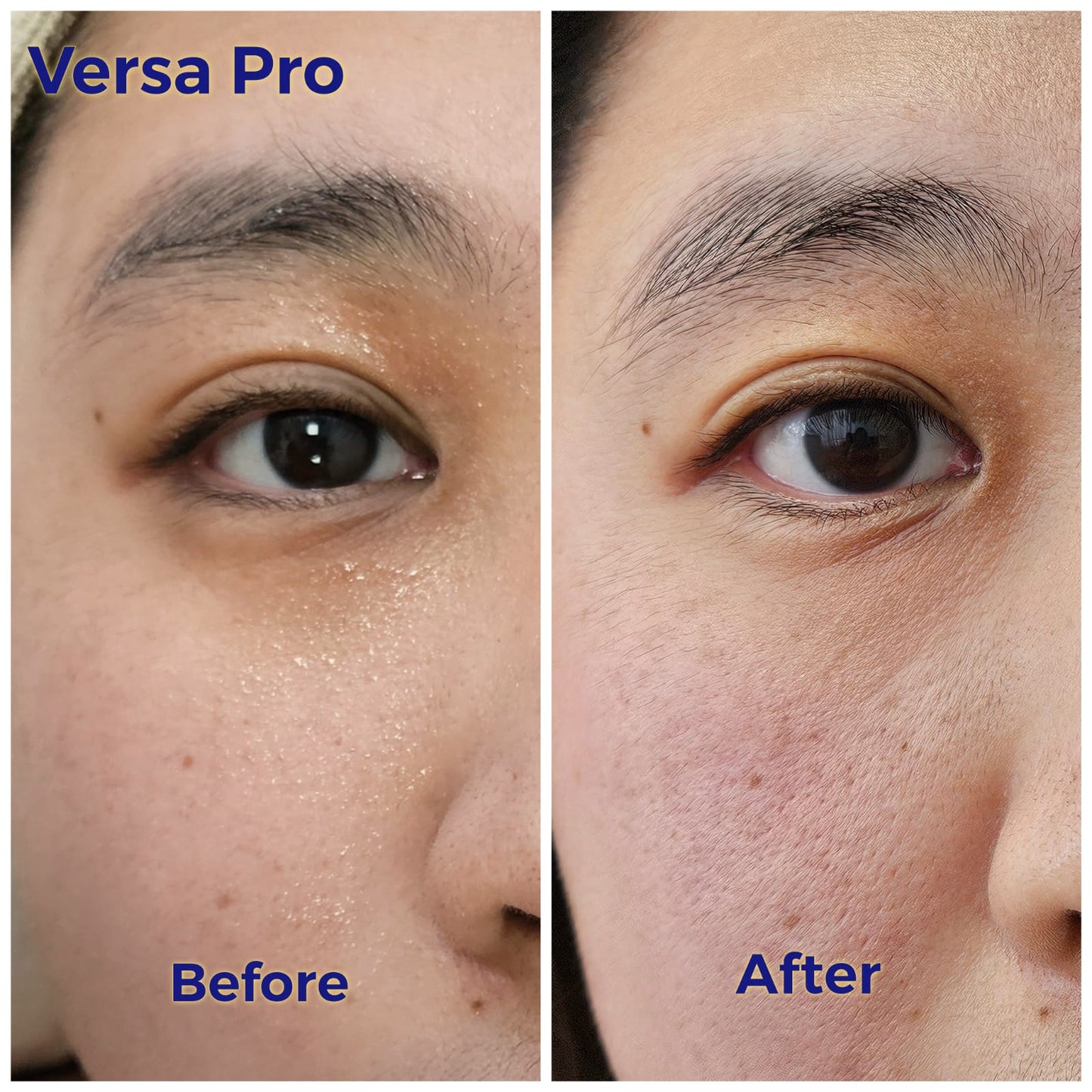 Venus Versa Pro 面部療程