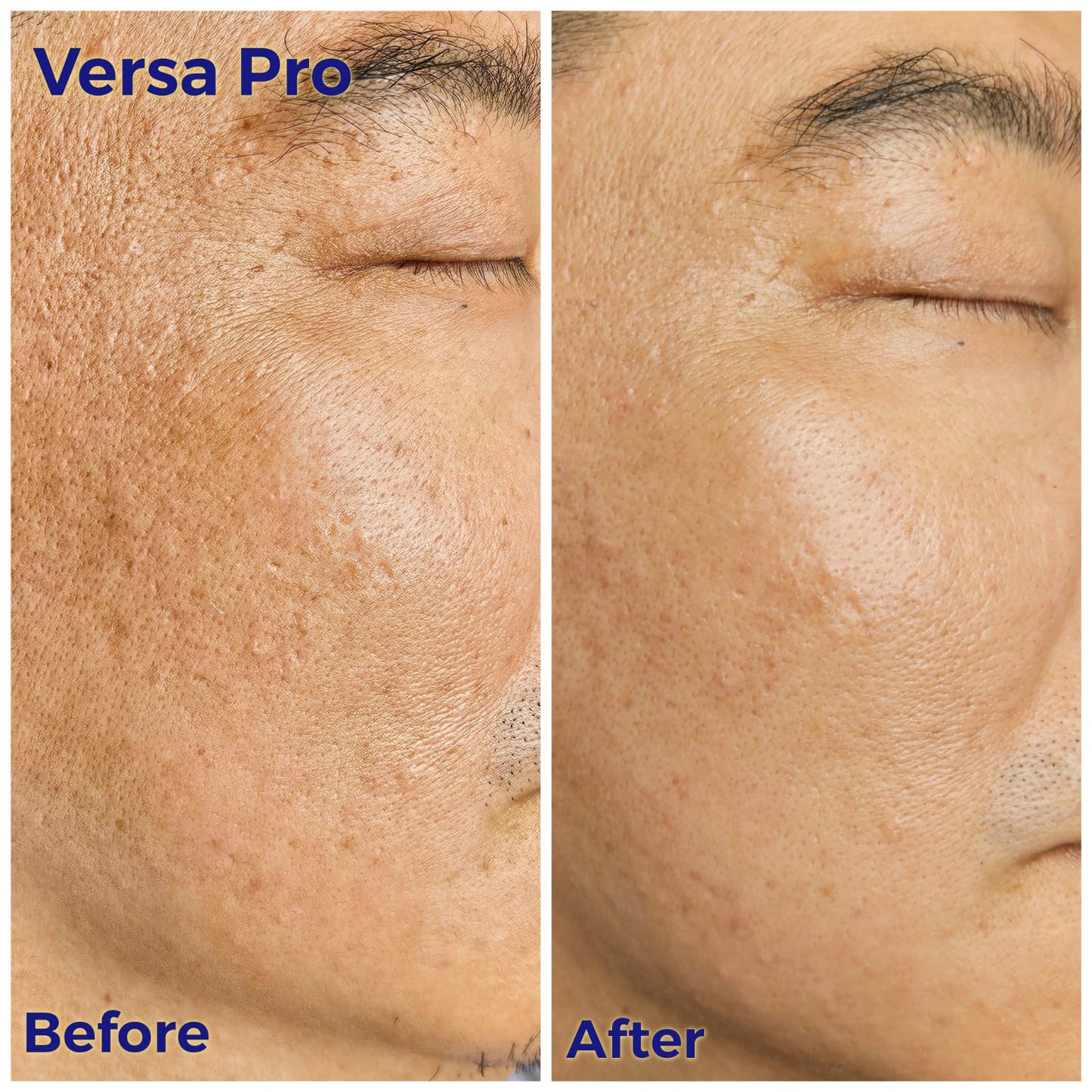 Venus Versa Pro 面部療程