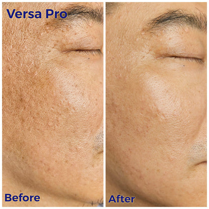 Venus Versa Pro 面部療程