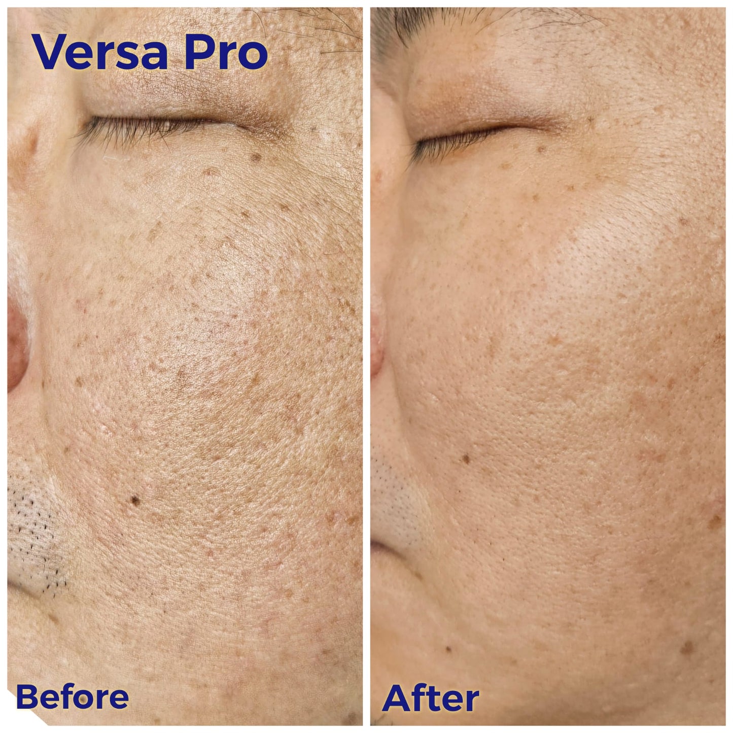 Venus Versa Pro 面部療程