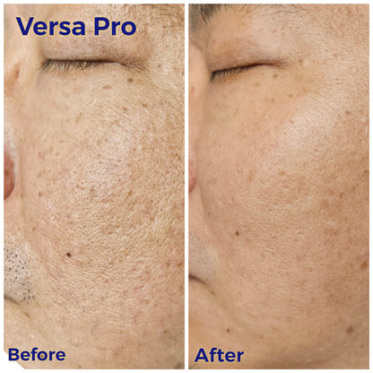 Venus Versa Pro 面部療程