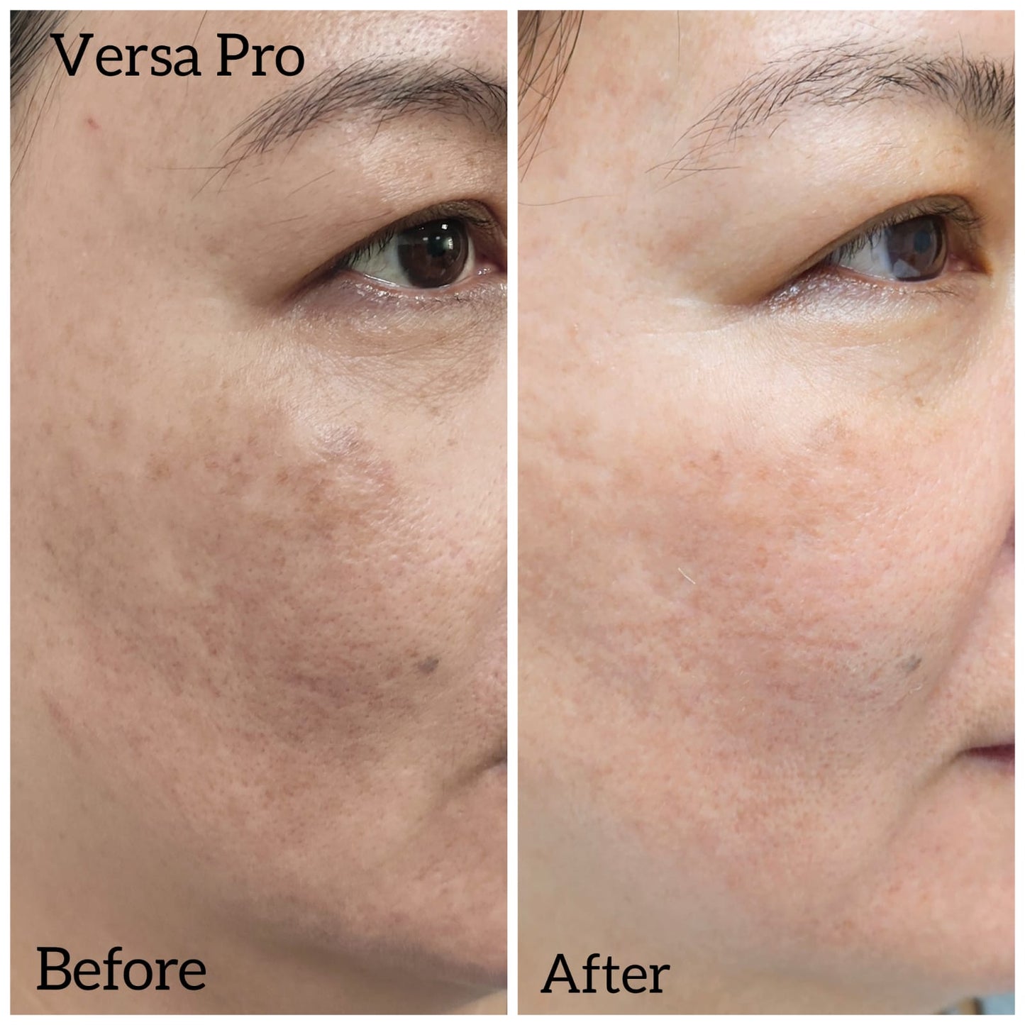 Venus Versa Pro 面部療程