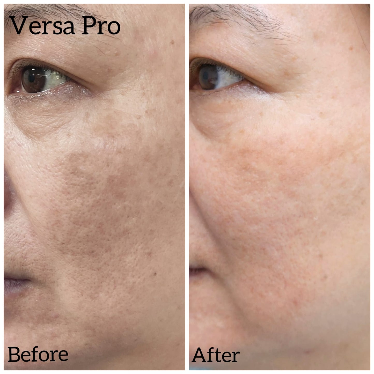 Venus Versa Pro 面部療程
